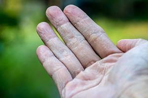 eczema-male-hand-2j